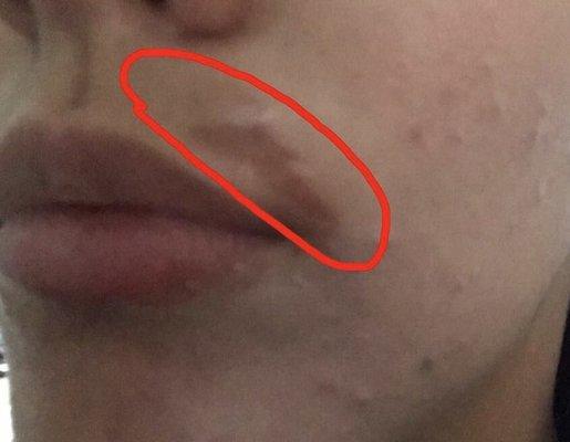 The second degree burn mark that was left on my face after getting waxed. Do not go here for waxing!!!