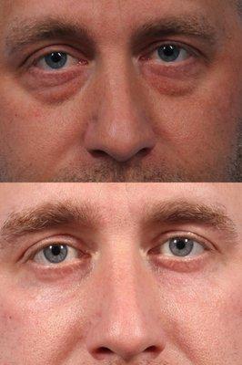 Lower eyelid surgery for eye bags