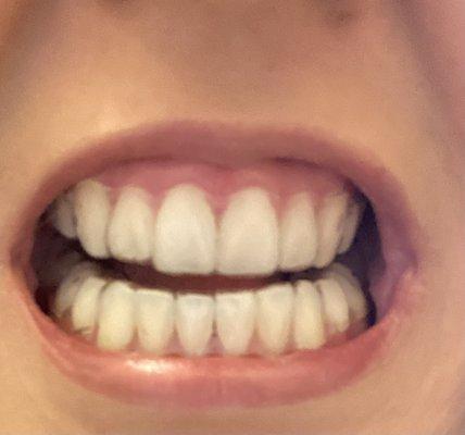 Braces removed and whitened with clear retainers