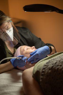 Microdermabrasion