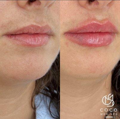 Lip injections / Lip filler by Amy