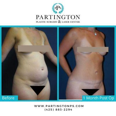 Look at this AMAZING tummy tuck before and after photo! Call Dr. Partington today to schedule your consultation!