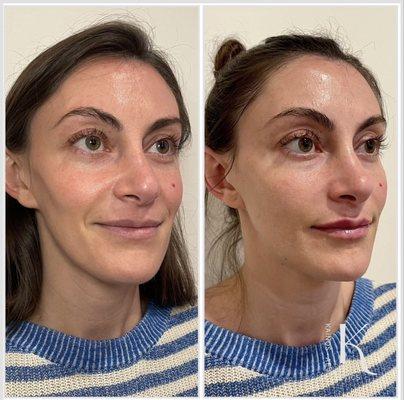 Full face rejuvenation