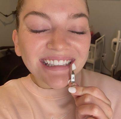 Try out Laser Teeth Whitening with Rise and Shine