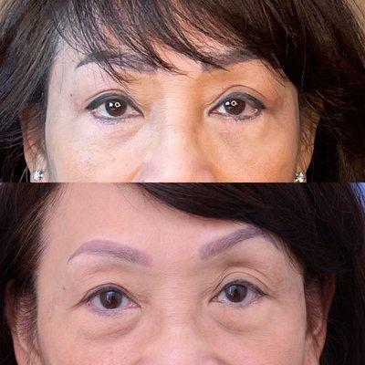 Before and after eyelid surgeries