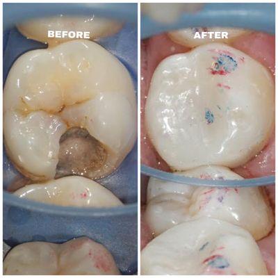 Tooth filling Endodontic work