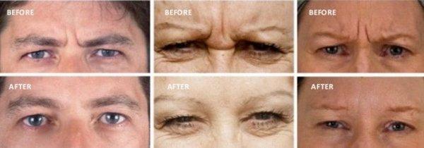 Botox Glabella Treatment