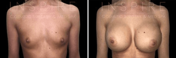 Breast Augmentation Before & After