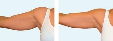 Arms pre/post Coolsculpting