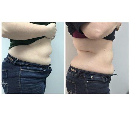 Ultrasonic Lipo & Pressaway Therapy