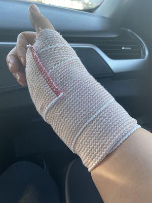 First surgery cast 12/13/19