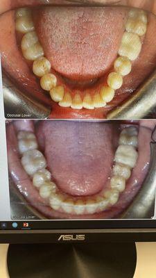 Teeth before and after (bottom)