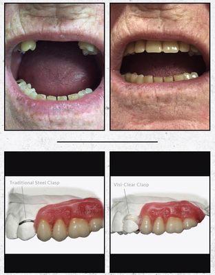 Before and After of front teeth replaced by partial denture using clear clasp