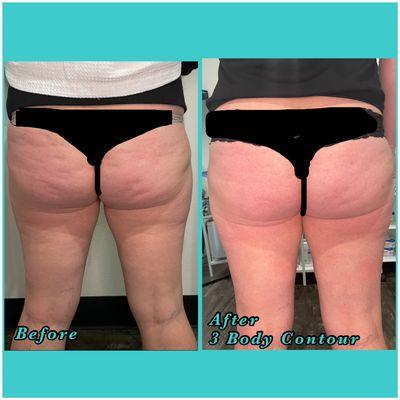 Body Contouring for Cellulite