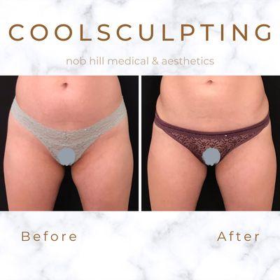 6 weeks after one session of inner thighs with Coolsculpting