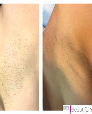 Laser hair removal