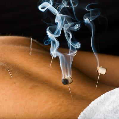 moxibustion