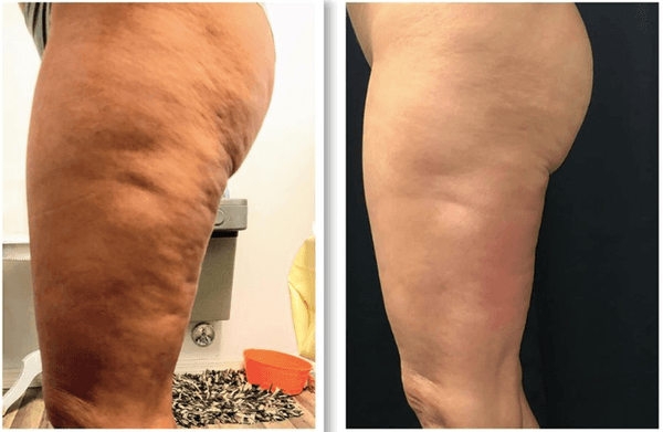 CryoToning cellulite reduction.