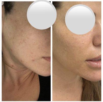 Acne Facial Before&After