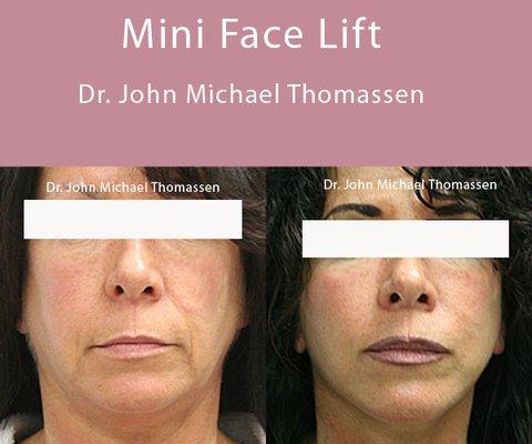 Fort Lauderdale Plastic Surgery by Dr. John Michael Thomassen - Board Certified Plastic Surgeon...