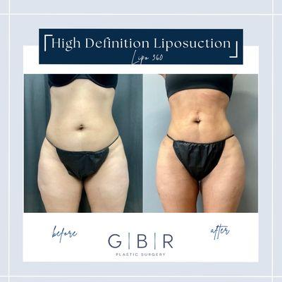 Liposuction in Virginia beach