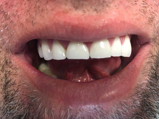 (2) After placement of veneers on teeth #5-12