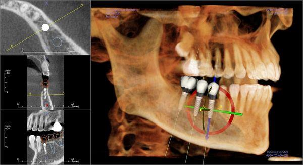 Precision placed implants