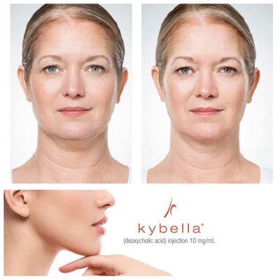 Bothered by fullness underneath your chin? Kybella is FDA-approved improves the appearance of moderate to severe submental fullness.