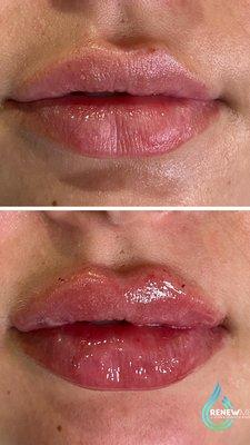 Lip Filler