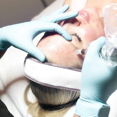 Microneedling is a dermaroller procedure that uses small needles to prick the skin. The purpose of treatment is to generate new collagen and