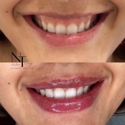 Gummy smile correction with Botox and Lip Filler