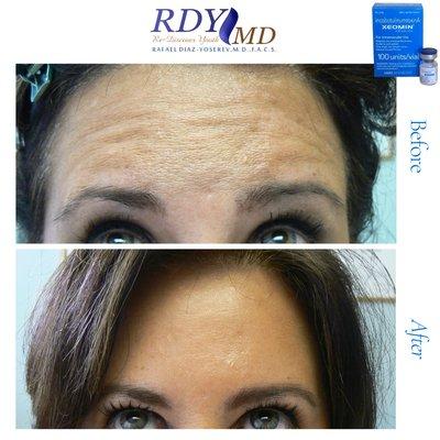 Xeomin / Botox / botulinum
Toxin a / dysport / daxify