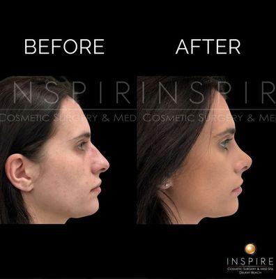 Before and after rhinoplasty by one of Inspire Cosmetic Surgery & Med Spa's Board Certified Plastic Surgeons.