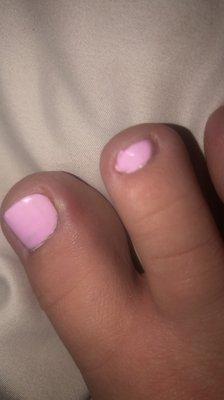 Nail infection