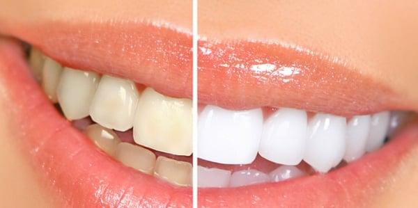 Teeth Whitening