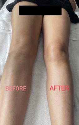 lymphatic massage on the legs is to boost the lymphatic system and drain excess fluid. You can see the huge difference.