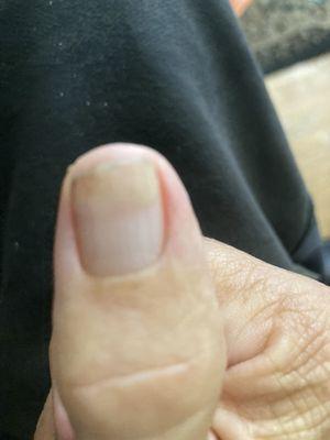 Split fingernail after Ana repaired it. Wow!