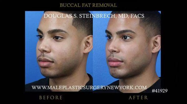 Buccal fat removal before and after photo