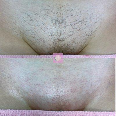 Brazilian Wax before & after