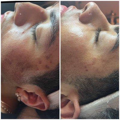 Acne Facial Progress from