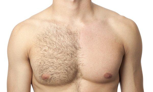 Men Laser Hair Removal!