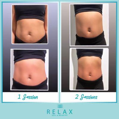 Body Contouring - results with 2 sessions.