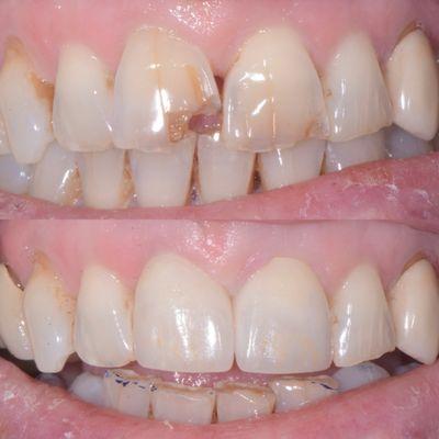 2 front esthetic crowns