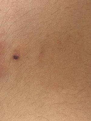 Skin Tag Removal by Dr. Kim - 6 days post op