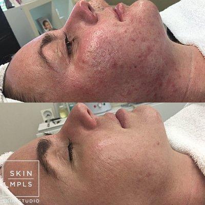 It took this client under 6 months with our recommendations and treatments to get clear skin after years of struggling with acne and redness