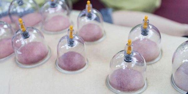 Chinese Cupping