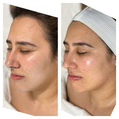 Lift, Define, & Glow - Our Facial Sculpting service Enhances your natural contours for a Radiant, Sculpted look that lasts!