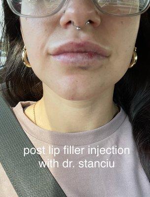 bruises as a result of rough lip filler injection technique with dr. stanciu