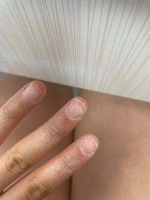 My damaged nails after removed