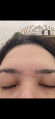 Allergy, uneven brows